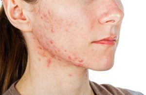 tipos-acne
