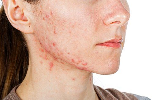 tipos-acne